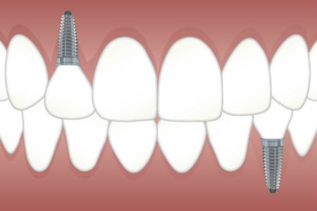 Ventajas de los implantes